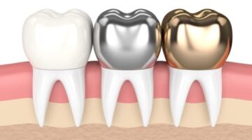 اكتشف أنواع تلبيسات الأسنان المدهشة دليلك الشامل لتجميل ابتسامتك وتعزيز ثقتك بنفسك!